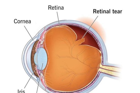 Retinal Tear