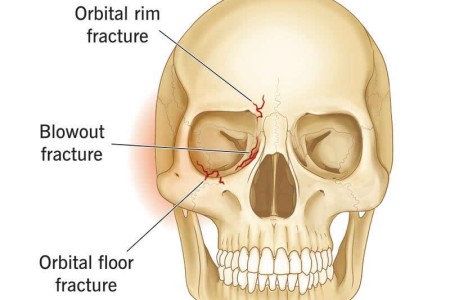 Orbital Fractures