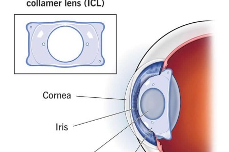 Implantable Collamer Lens (ICL) Surgery