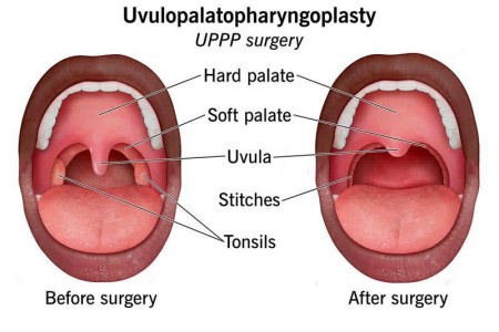 Uvulopalatopharyngoplasty (UPPP Surgery)