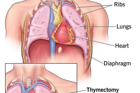 Thymectomy