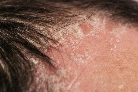 Psoriasis on the Face