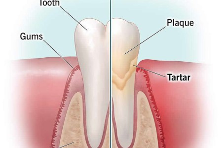 Tartar