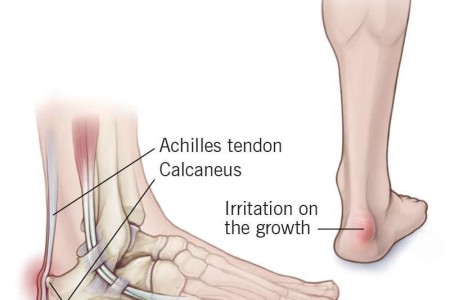 Haglund’s Deformity