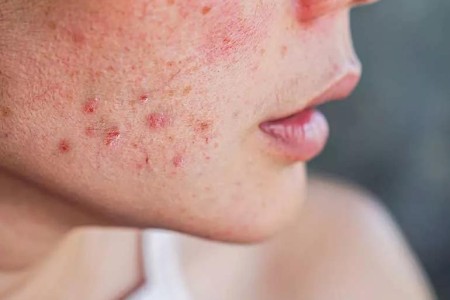 The Breakout Breakdown: Why You Get Acne Around Your Period