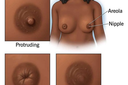 Flat and Inverted Nipples