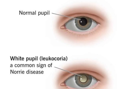 Norrie Disease
