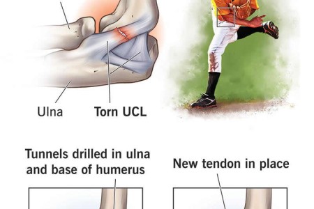 Tommy John Surgery (UCL Surgery)