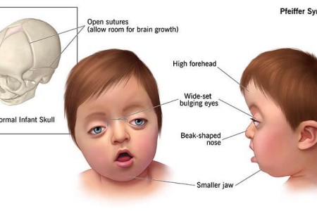 Pfeiffer Syndrome