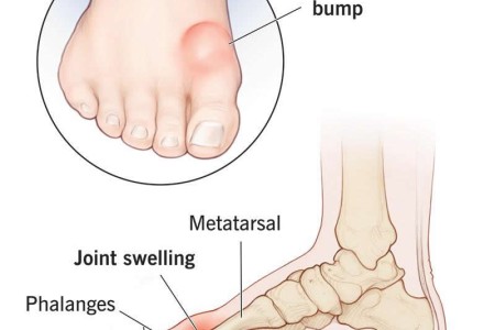 Hallux Limitus