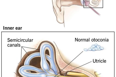 Benign Paroxysmal Positional Vertigo (BPPV)