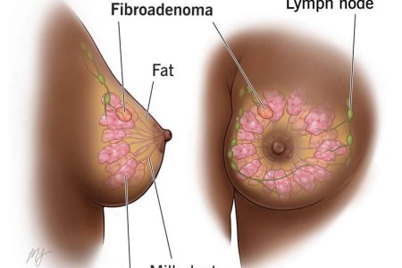 Fibroadenoma