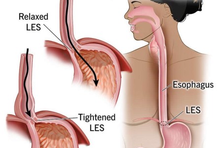 Achalasia (Cardiospasm)