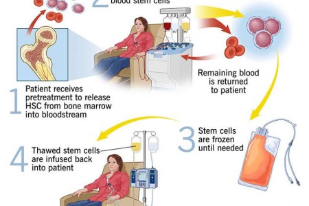 Stem Cell Transplant (Bone Marrow Transplant)