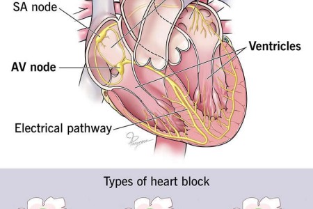 Heart Block