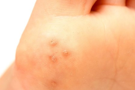 Warts