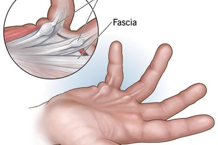 Dupuytren Contracture