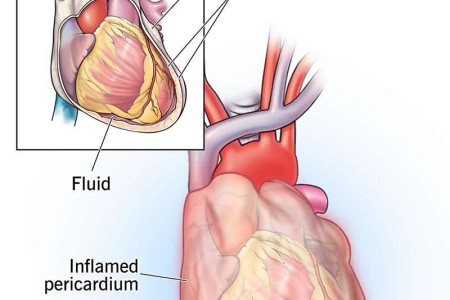 Acute Pericarditis