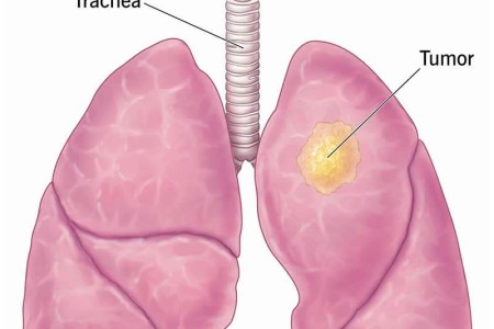 Lung Cancer
