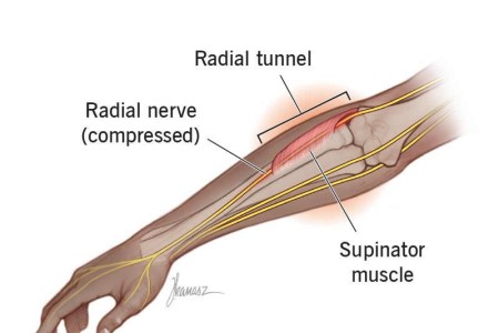 Radial Tunnel Syndrome