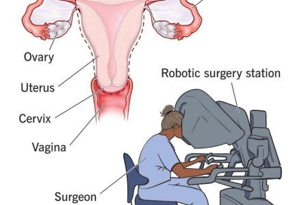 Robotic-Assisted Hysterectomy