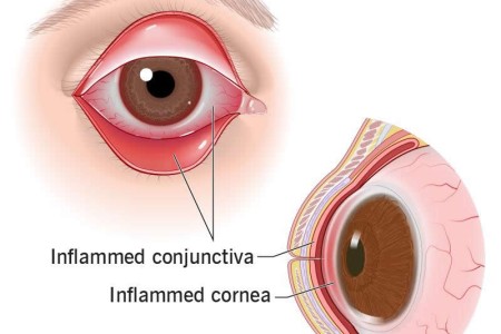 Keratoconjunctivitis