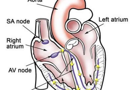 Arrhythmias in Children