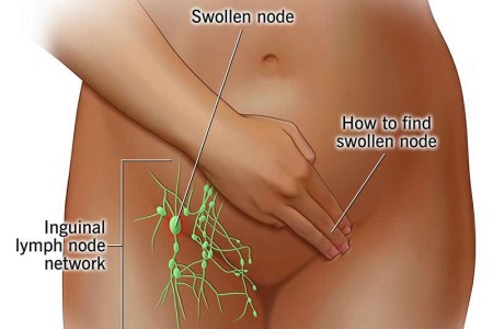 Inguinal Lymph Node