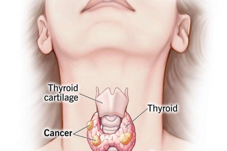Thyroid Cancer