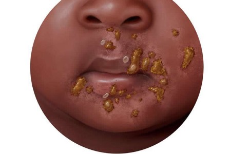 Impetigo