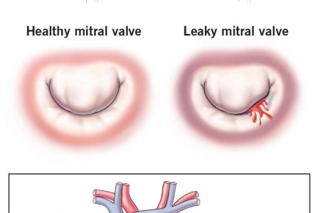 Leaky Heart Valve