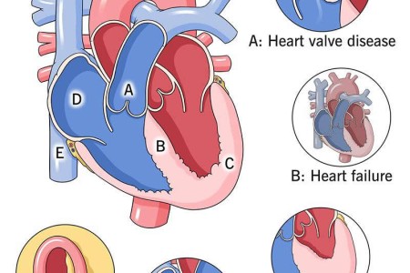 Heart Disease