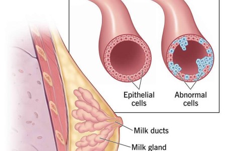 Ductal Carcinoma in Situ (DCIS)