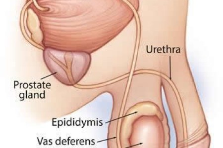 Testicular Cancer