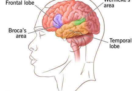 Aphasia