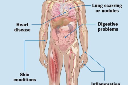 Rheumatoid Arthritis