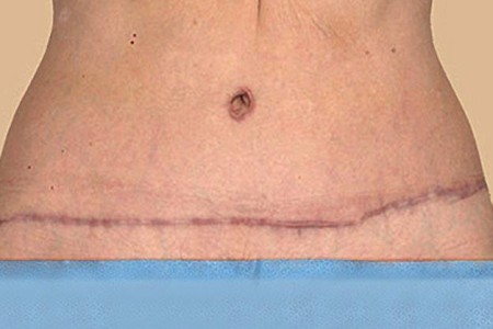 Tummy Tuck Scar