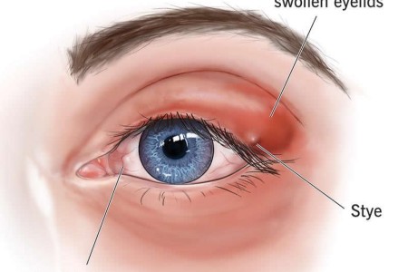 Ocular Rosacea