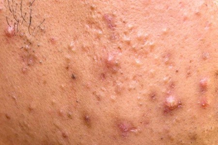 Acne Papules
