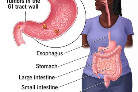 Gastrointestinal Stromal Tumor (GIST)