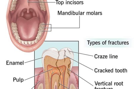 Cracked Tooth (Fractured Tooth)