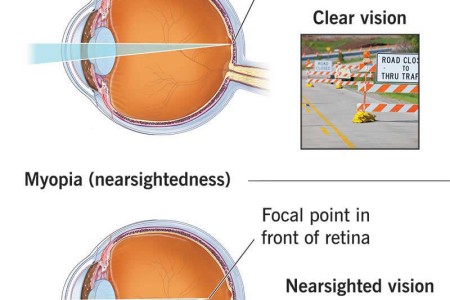 Myopia (Nearsightedness)
