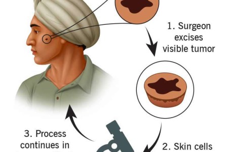 Mohs Surgery