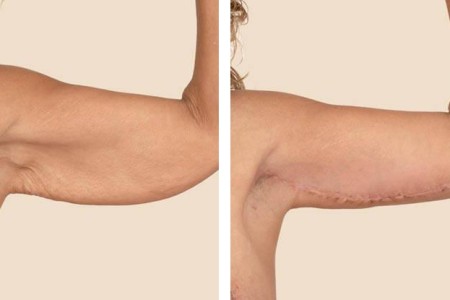 Brachioplasty (Arm Lift)