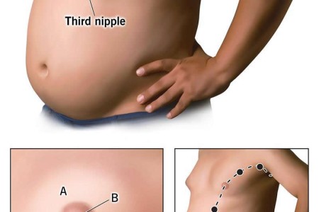 Third Nipple