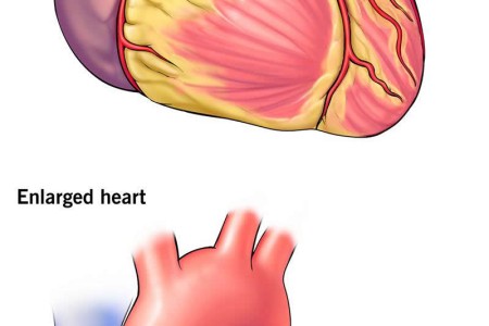 Enlarged Heart (Cardiomegaly)