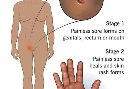 Syphilis