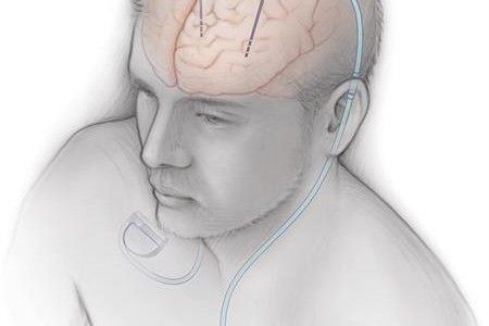 Deep Brain Stimulation