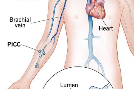 PICC Line (Peripherally Inserted Central Catheter)