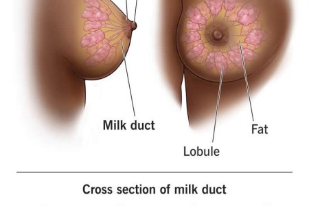 Atypical Ductal Hyperplasia